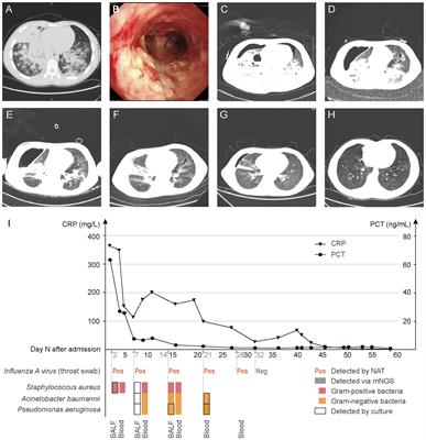 Case Report: Metagenomic next-generation sequencing assists in dynamic pathogen monitoring: powerful tool for progressing severe pneumonia